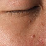 Skin Tags, Warts and Seborrheic Keratosis: What’s the Difference?